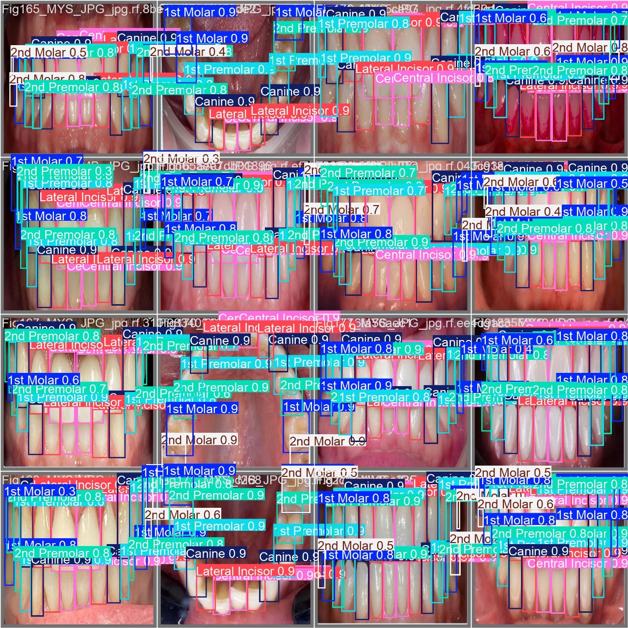 Teeth Disease Detection